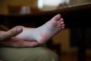 hand foot and mouth disease