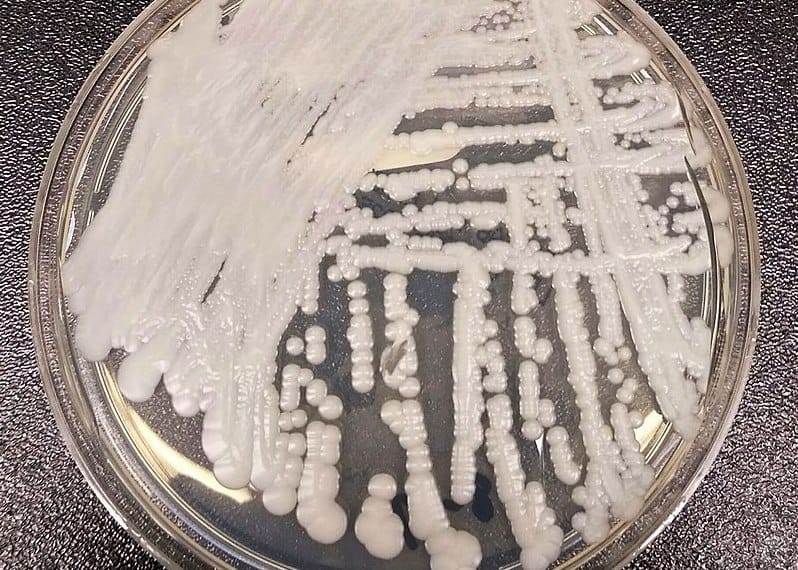 Superbug Candida Auris Now Reported in More Than Half of States